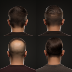 500 Grafts Hair Transplant showing detailed hair growth, incorporating various shades of brown.
